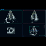 Модуль Количественного Анализа 3D изображений сердца (3DQ)