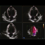 HeartModel  ‑ полностью автоматизированный инструмент количественного анализа в Live 3D для кардиологии